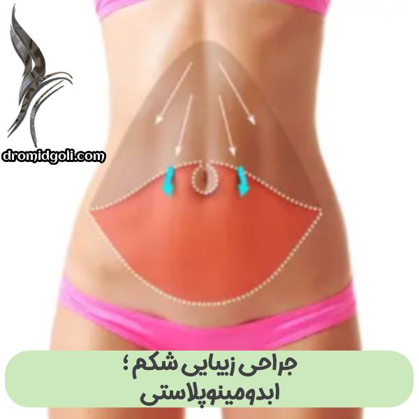 جراحی زیبایی شکم