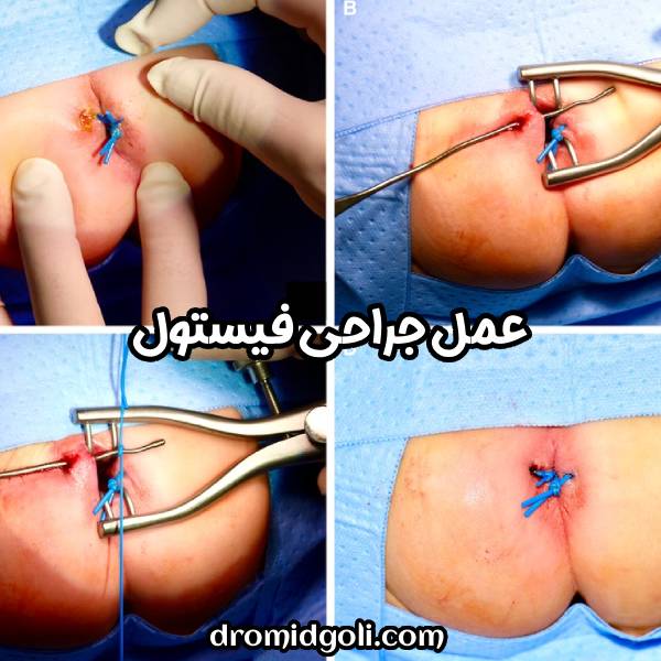 عمل جراحی فیستول
