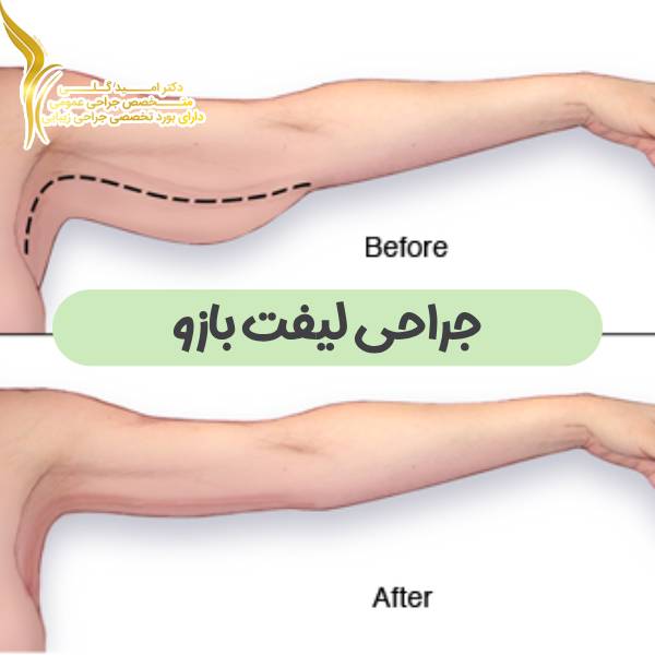 جراحی لیفت بازو