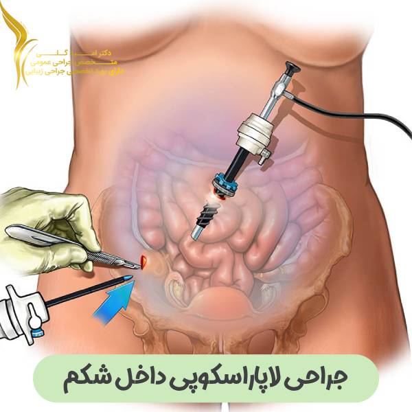 جراحی لاپاراسکوپی داخل شکم