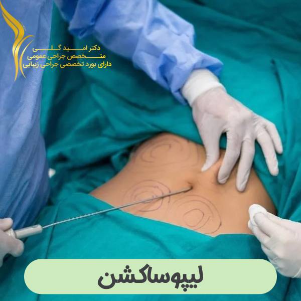 عمل لیپوساکشن