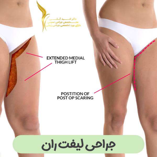 جراحی لیفت ران