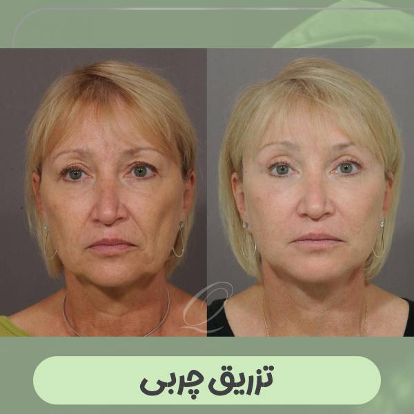 تزریق چربی