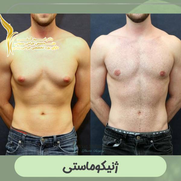 ژنیکوماستی