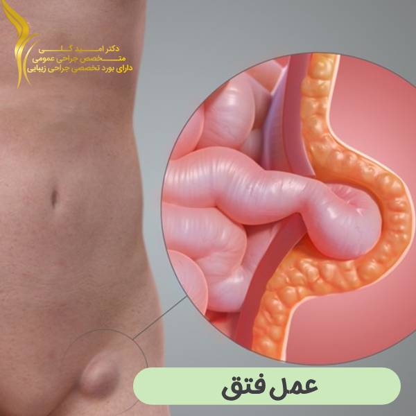 عمل فتق