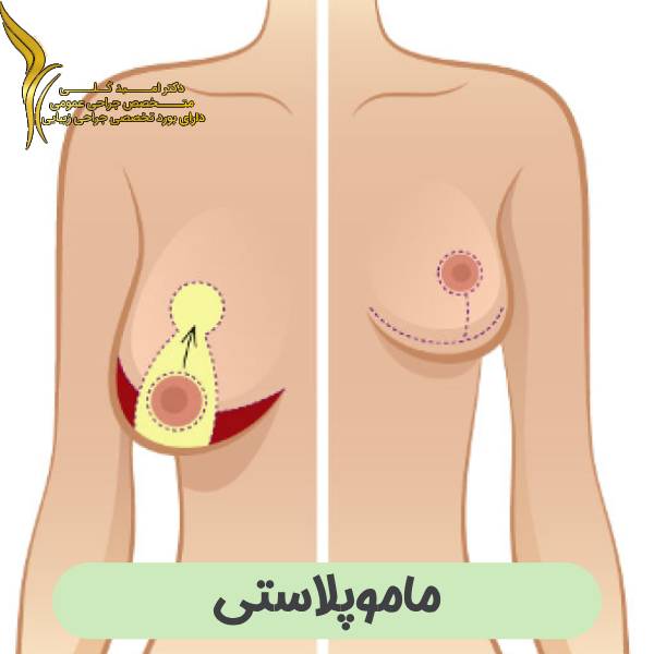 ماموپلاستی