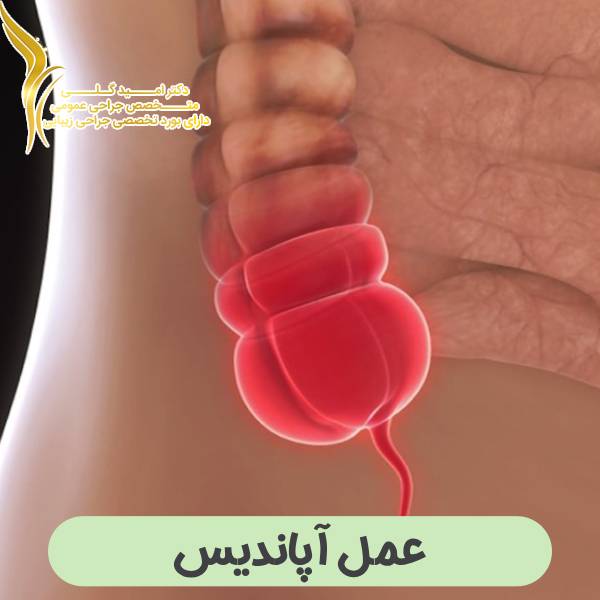 عمل آپاندیس
