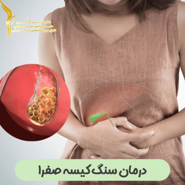 درمان سنگ کیسه صفرا