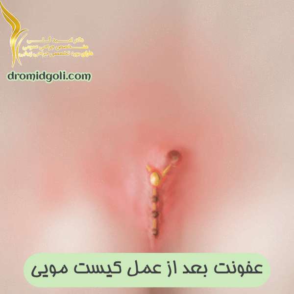 عفونت بعد از عمل کیست مویی