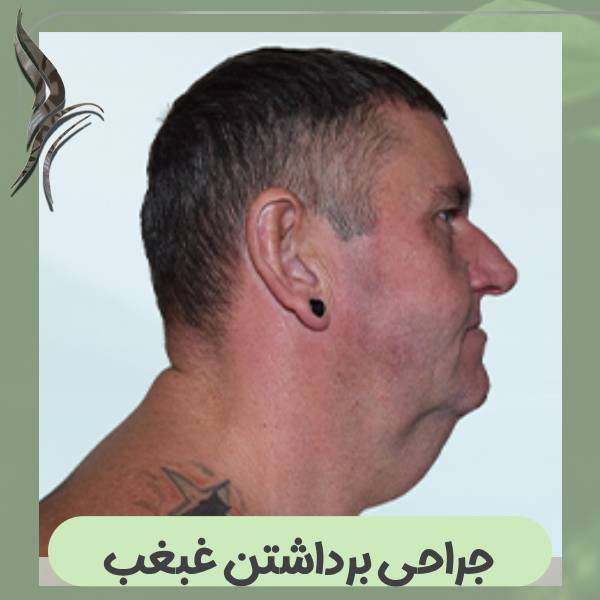 جراحی غبغب