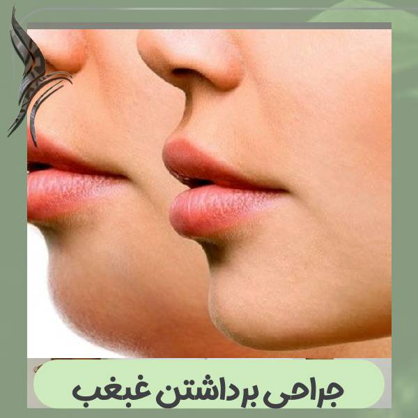 جراحی غبغب
