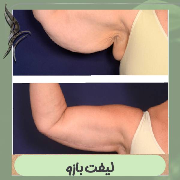 لیفت بازو در کرج