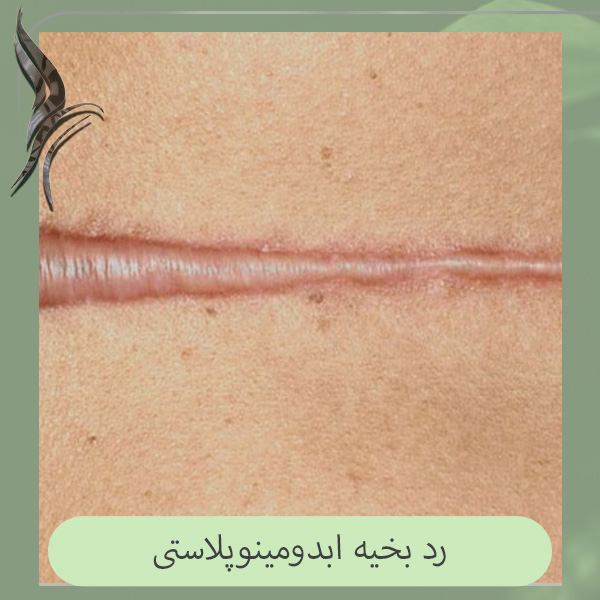 بخیه ابدومینوپلاستی