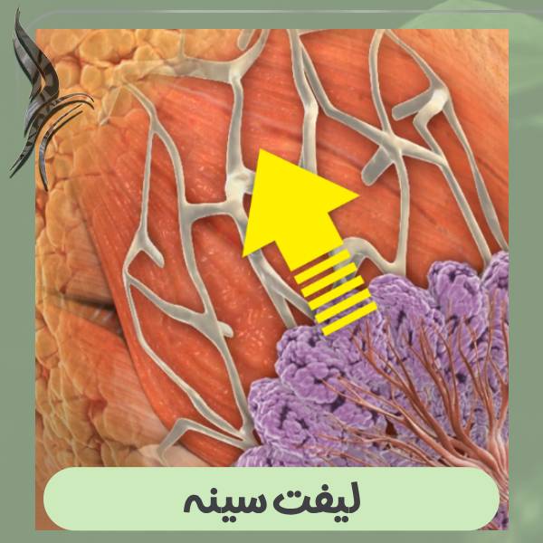 لیفت سینه