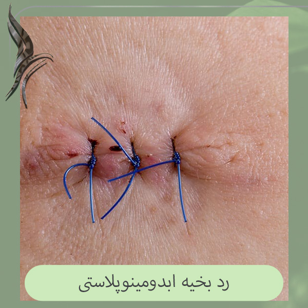 بخیه ابدومینوپلاستی