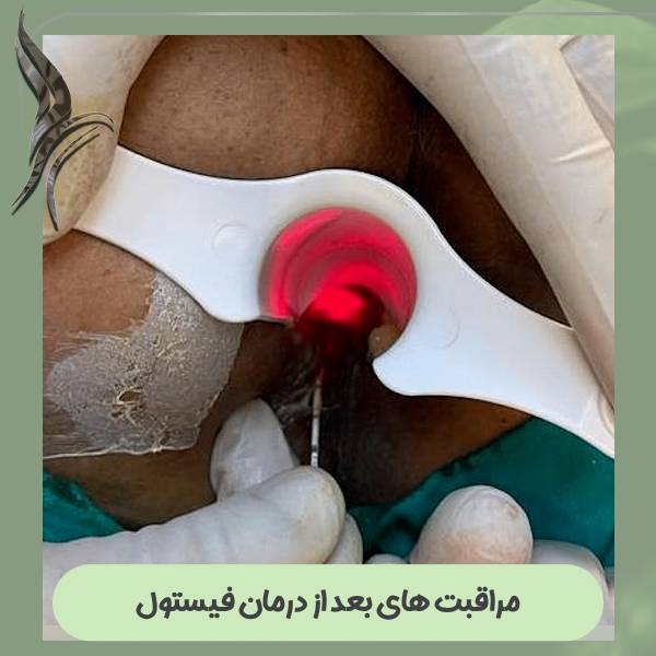 مراقبت های بعد از درمان فیستول