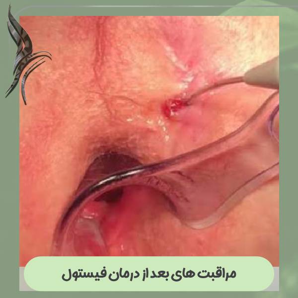 مراقبت های بعد از درمان فیستول