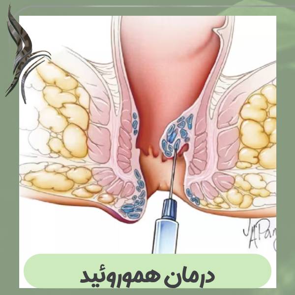 درمان هموروئید