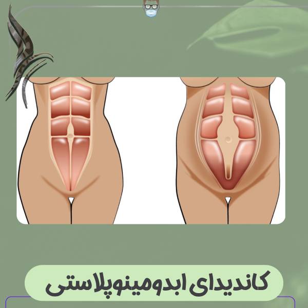 کاندیدای ابدومینوپلاستی