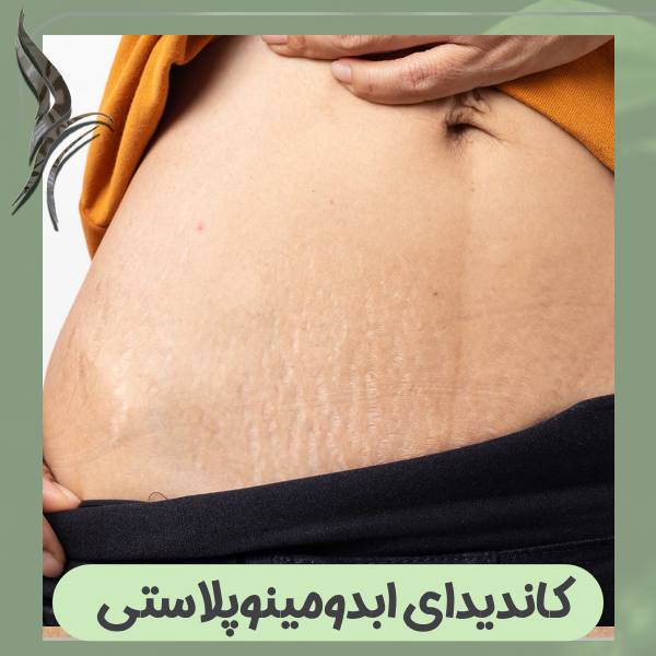 کاندیدای ابدومینوپلاستی
