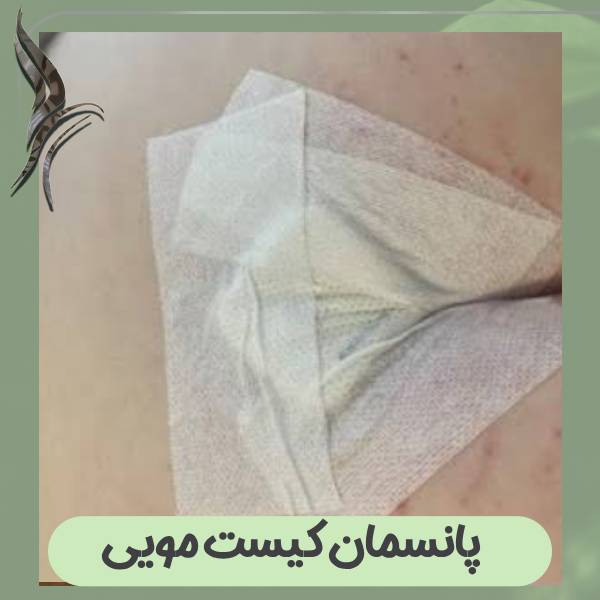 پانسمان کیست مویی