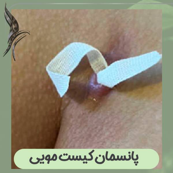 پانسمان کیست مویی
